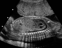 Foetal_ultrasound_scan