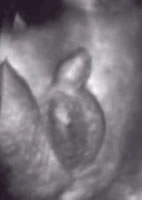 Figure 3 - 3D image of a foetus in the womb (the baby is a boy if you'd not guessed !) - Click to enlarge.