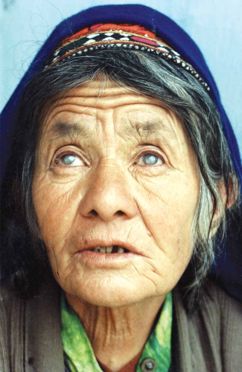 Woman cataracts