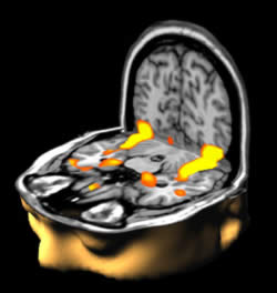Figure 4. When you recognize a familiar face the parts of the brain highlighted in orange on this functional magnetic resonance image (fMRI) light up. In this case 'lighting up' means there is increased blood flow to the areas that are working hardest. Functional MRI allows these regions to be visualized. Winning image from the Wellcome Trust Biomedical Image Award in 2003 (image courtesy Mark Lythgoe and Chloe Hutton).