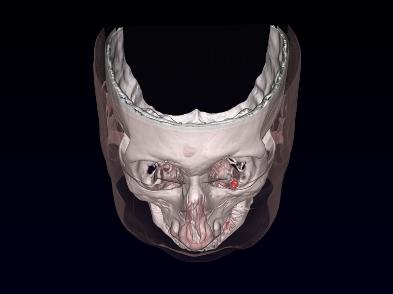 Magnetic prosthesis for nystagmus
