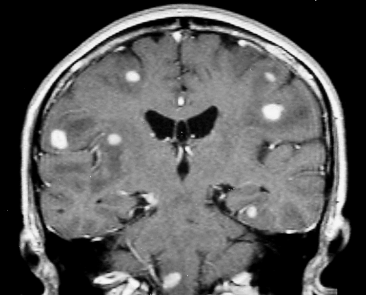 Aspirin helps to reduce inflammation and the number of strokes associated with tuberculous meningitis.