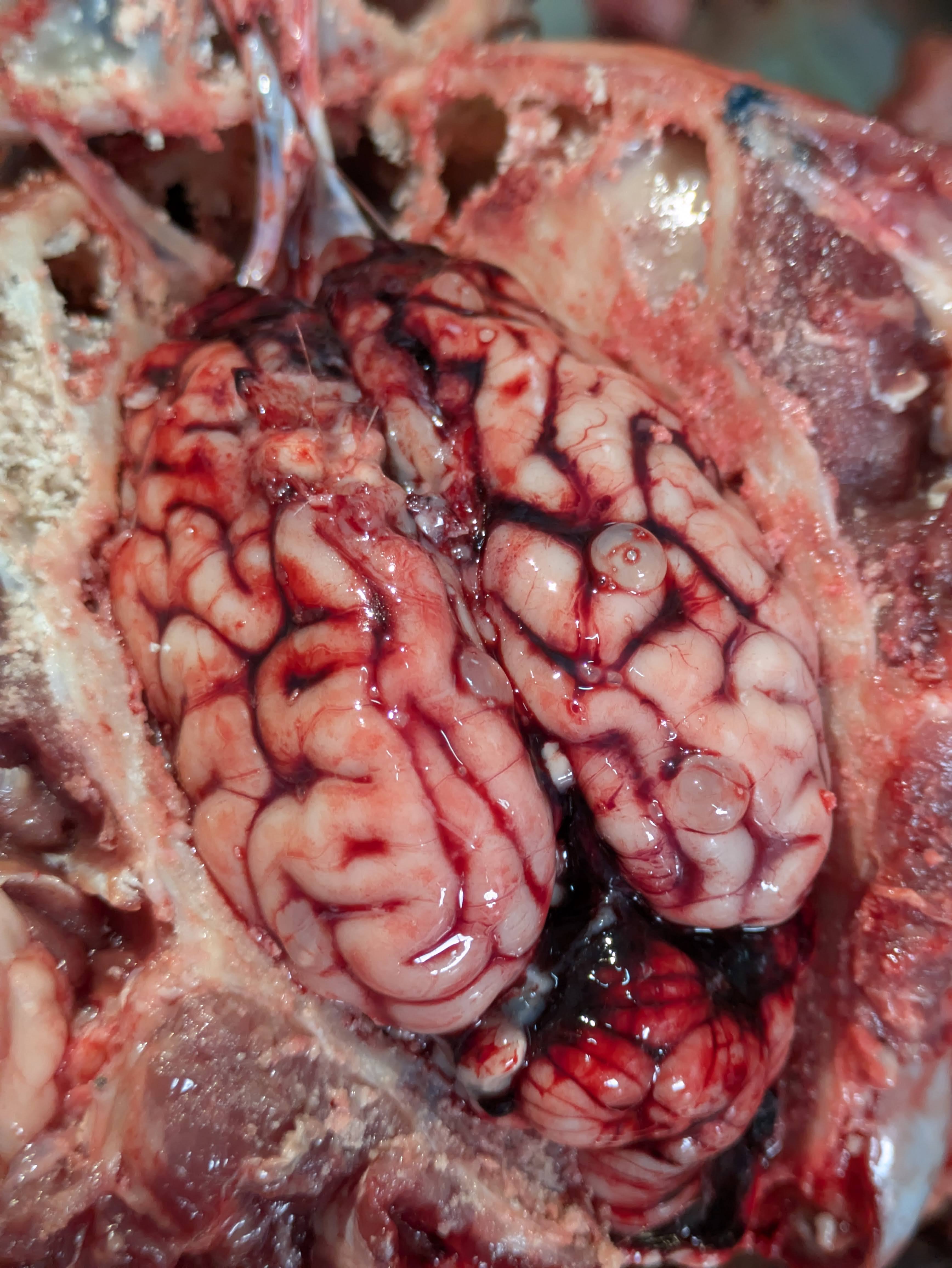 Cysicercosis: brain cysts caused by larvae of the pig tapeworm 