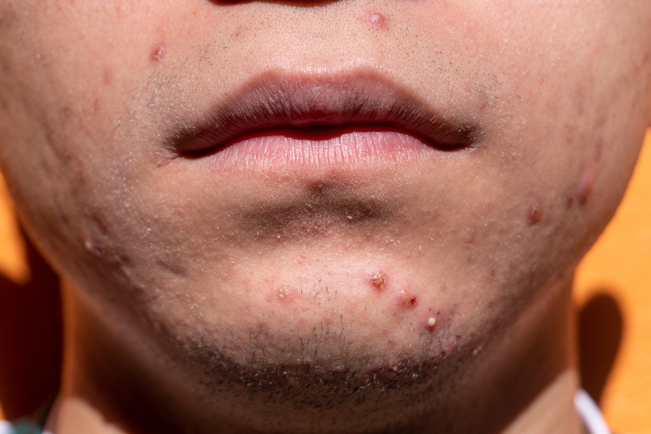 Acne - spots on a person's chin