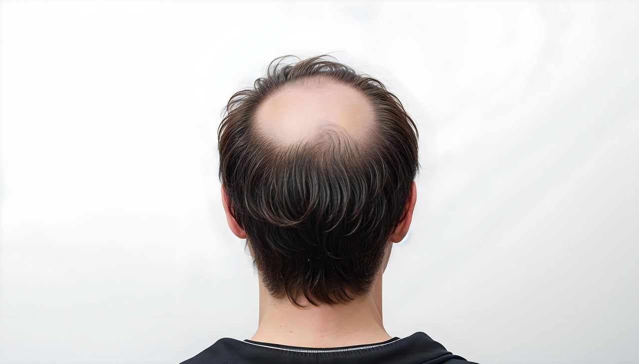 Hair loss