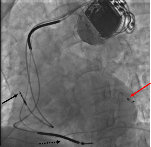 A heart pacemaker implanted into a patient