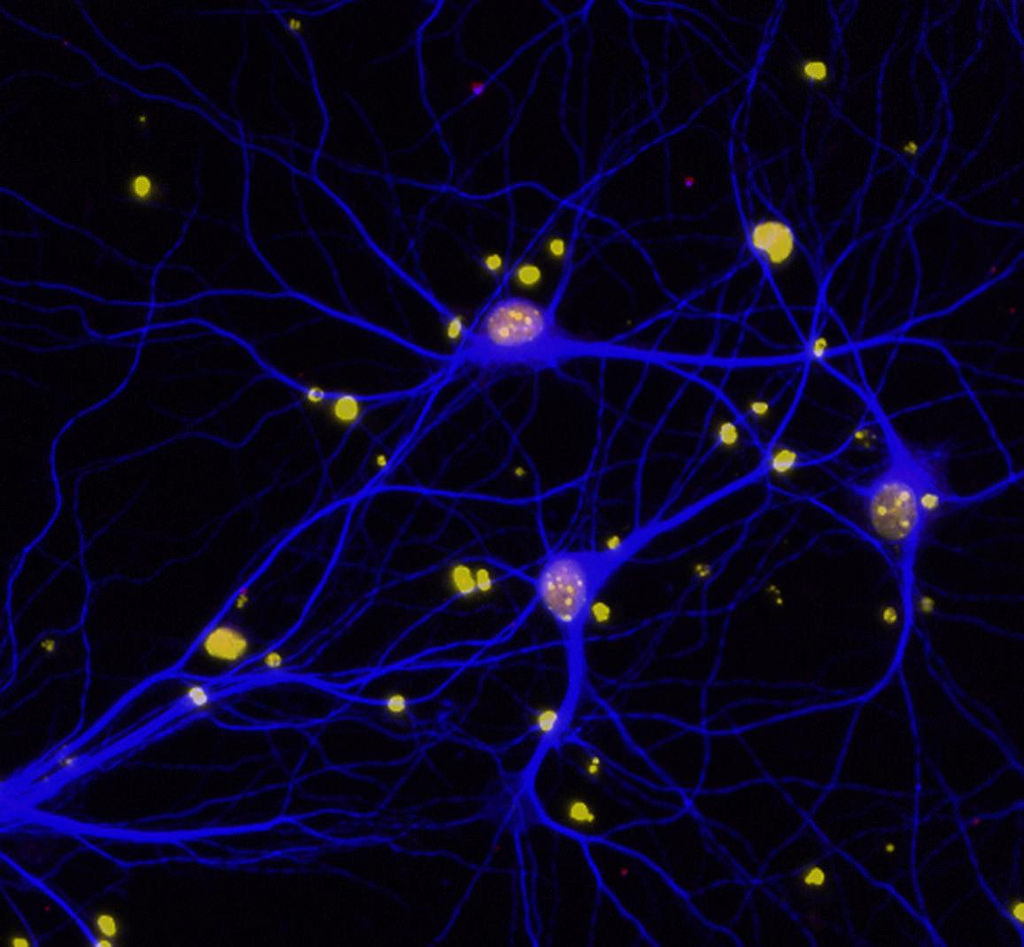Dementia neuron