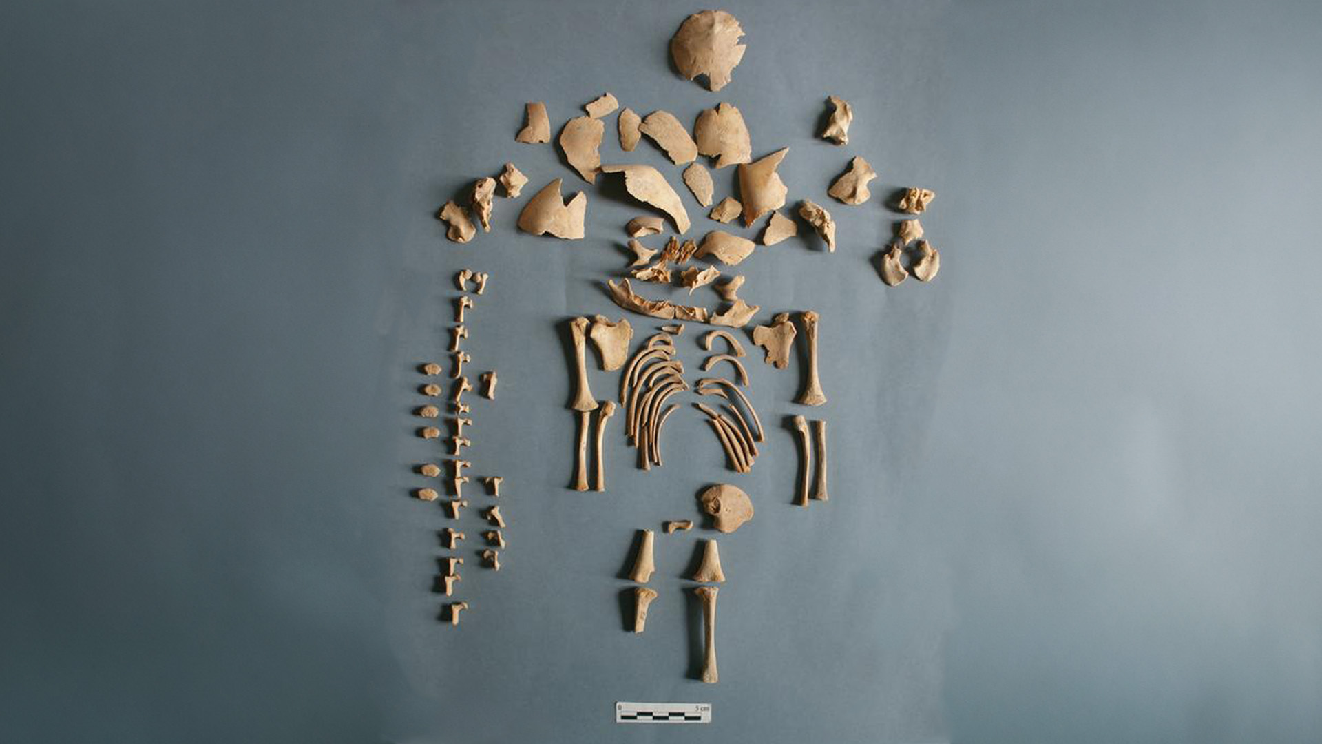 Down's syndrome skeletal remains