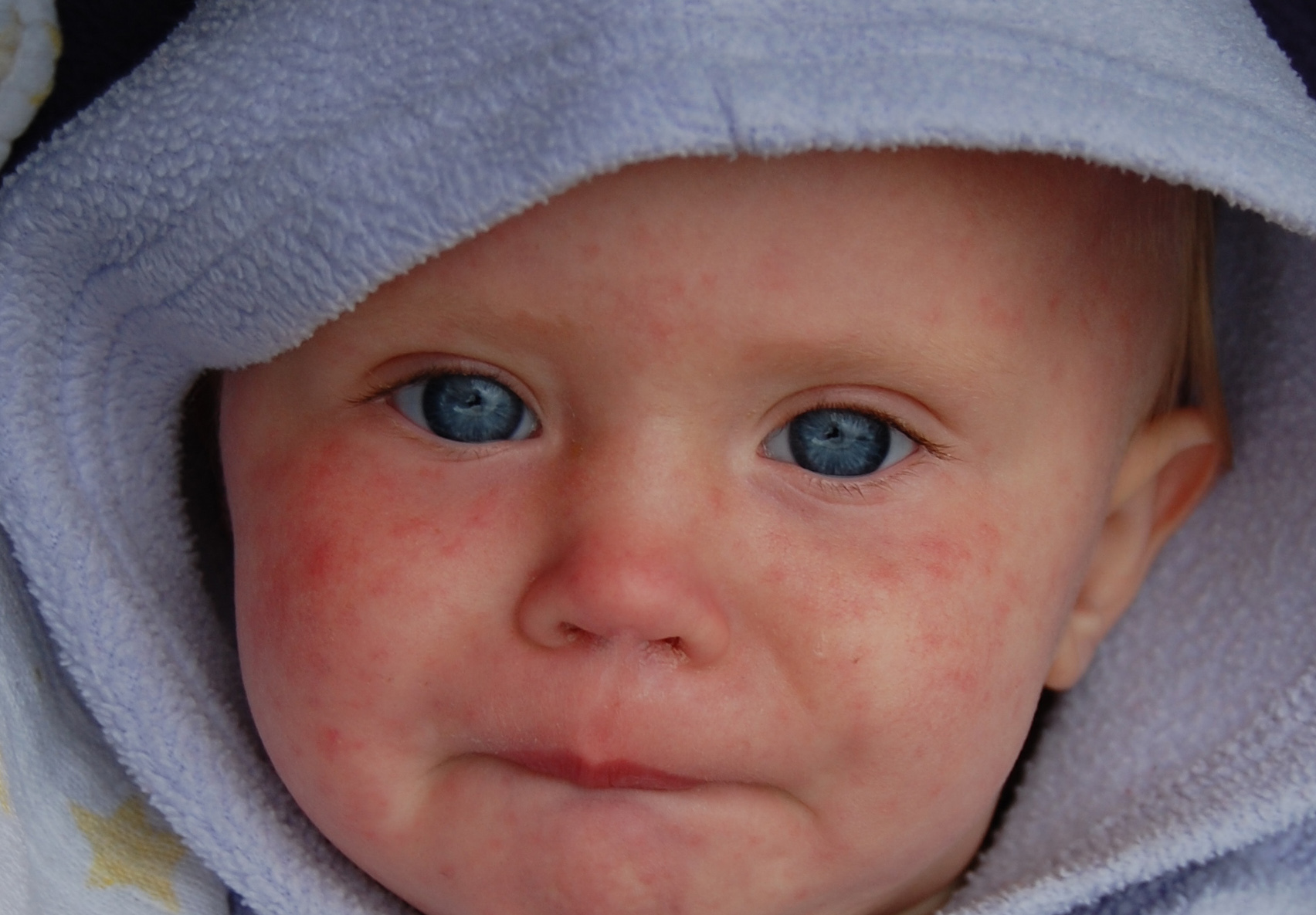 Baby with measles