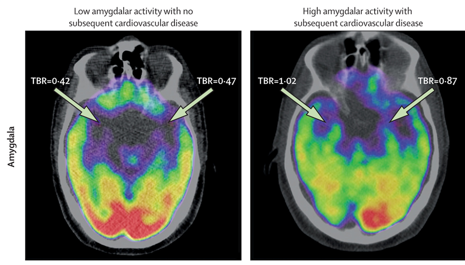 Emotional stress is associated with increased risk of cardiovascular disease. 