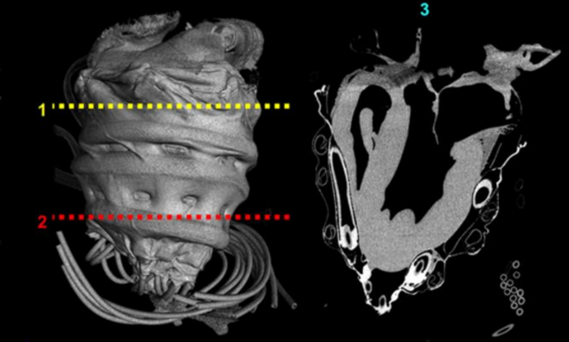Robotic sleeve for heart failure