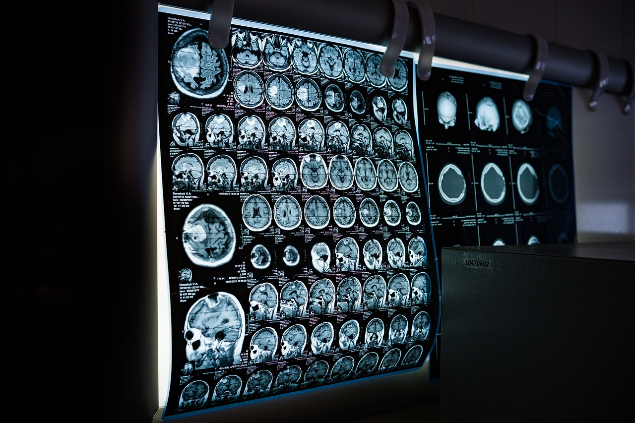 MRI scans