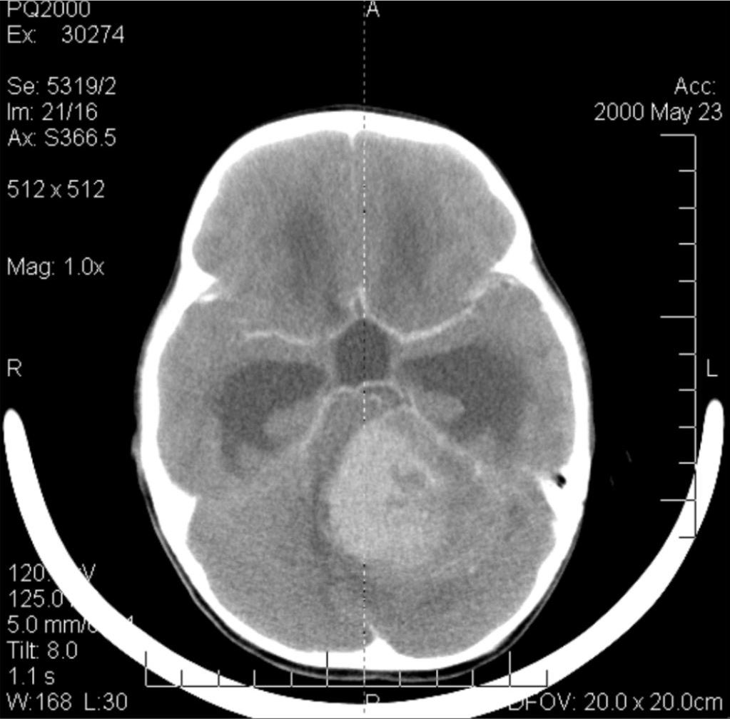 Medulloblastoma, paediatric brain scan