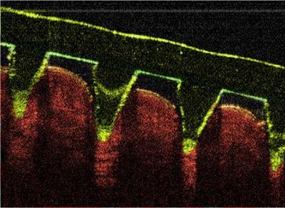 Microneedles pierce skin painlessly to deliver drugs and even remove blood samples for analysis.