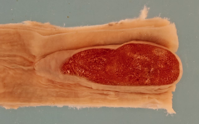 Oesophageal lipoma