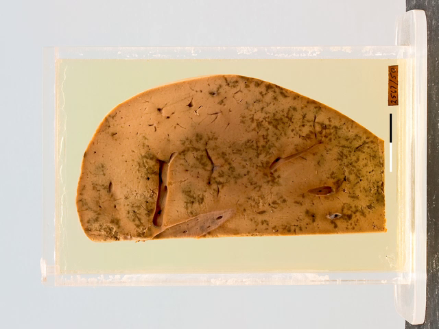 Eclamptic necrosis of the liver