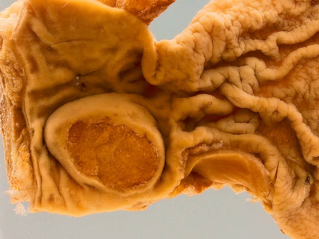 Lipoma (Duodenum)
