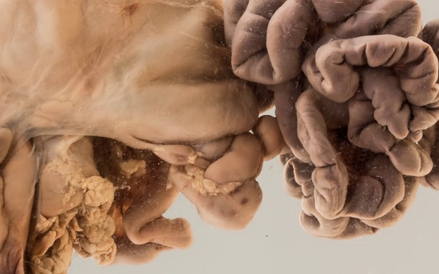 Volvulus neonatorum