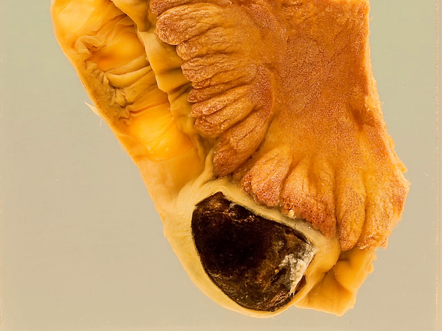 Gallstone ileus