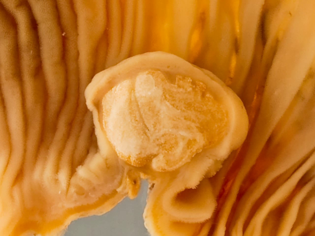 Lipoma of the small intestine