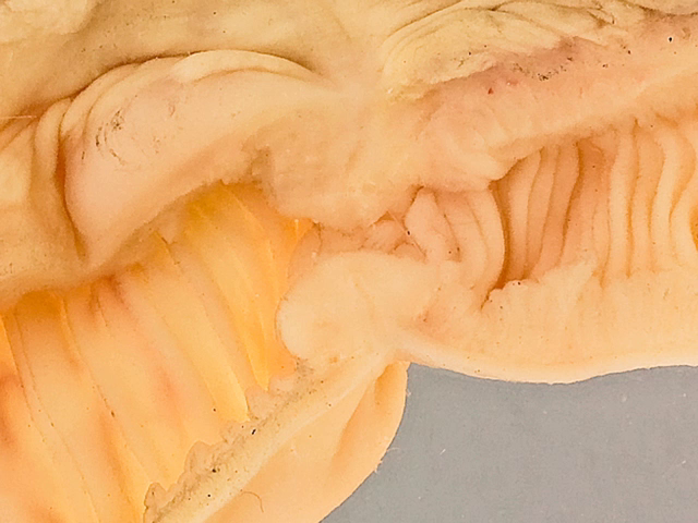 Adenocarcinoma of the small intestine