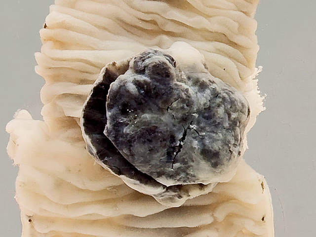 Leiomyosarcoma of the jejunum (GIST)
