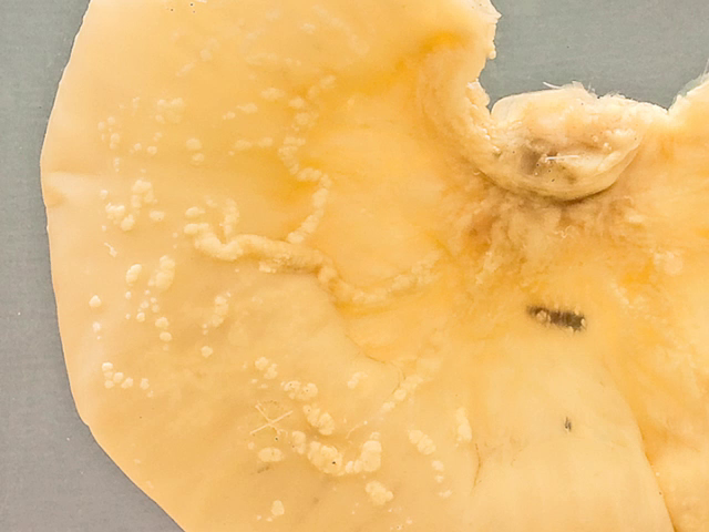 Lymphangitis carcinomatosa