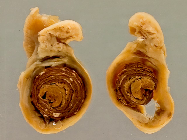 Appendicitis (faecolith)