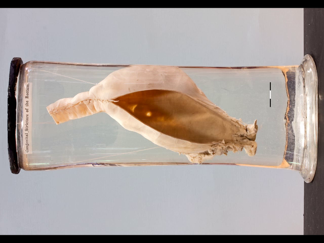 Imperforate anus