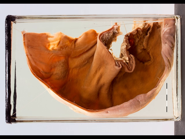 Megacolon