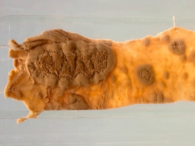 Typhoid ulceration (Ileum)