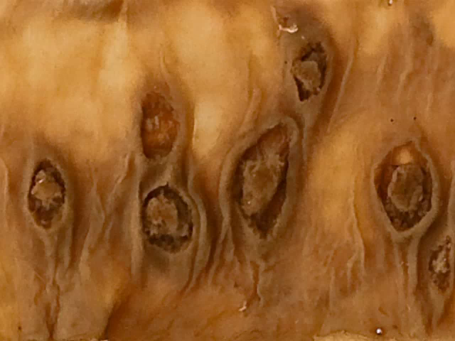Typhoid ulceration of the GI tract