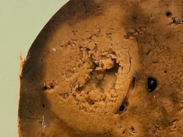 Amoebiasis of the colon with liver abscesses