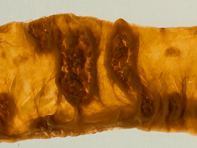 Primary tuberculosis (ileum)