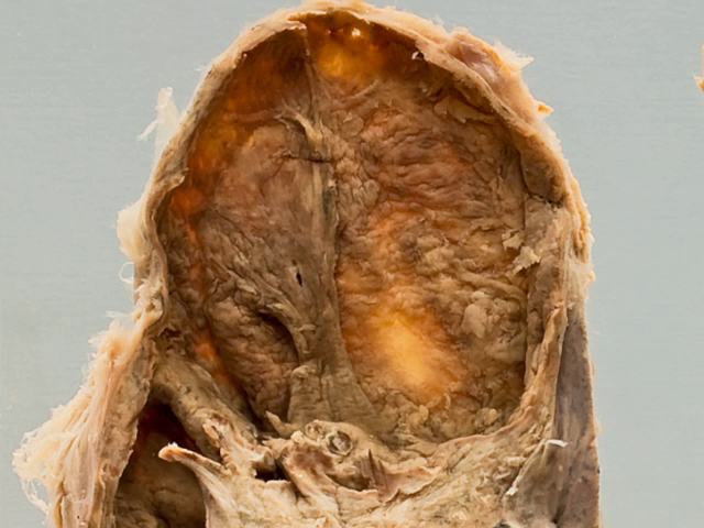 Tuberculosis