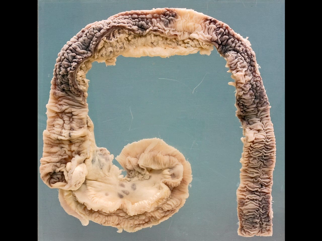 Crohn's disease
