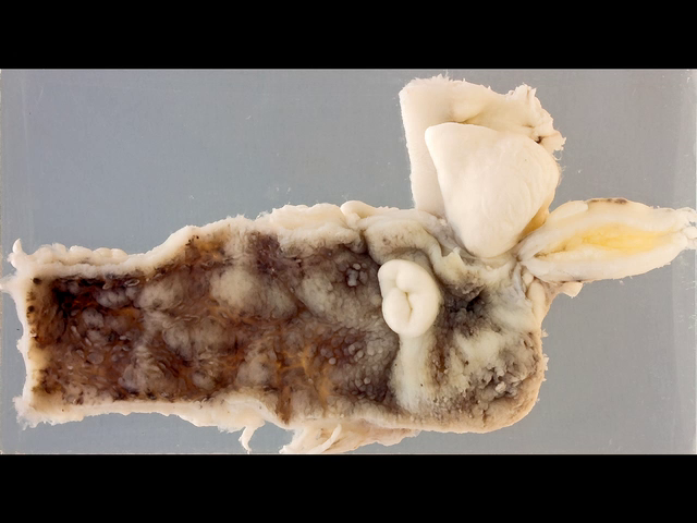 Ulcerative colitis
