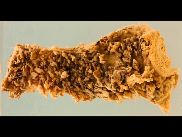 Ulcerative colitis