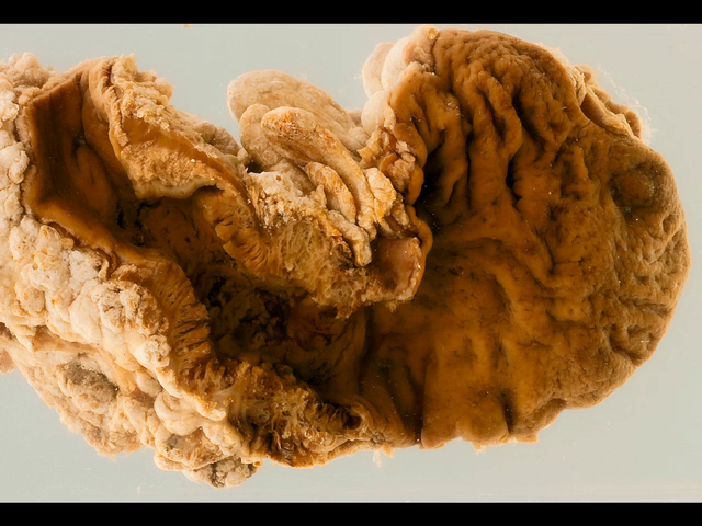 Adenocarcinoma developing in ulcerative colitis