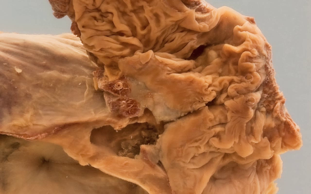 Colo-vesical fistula