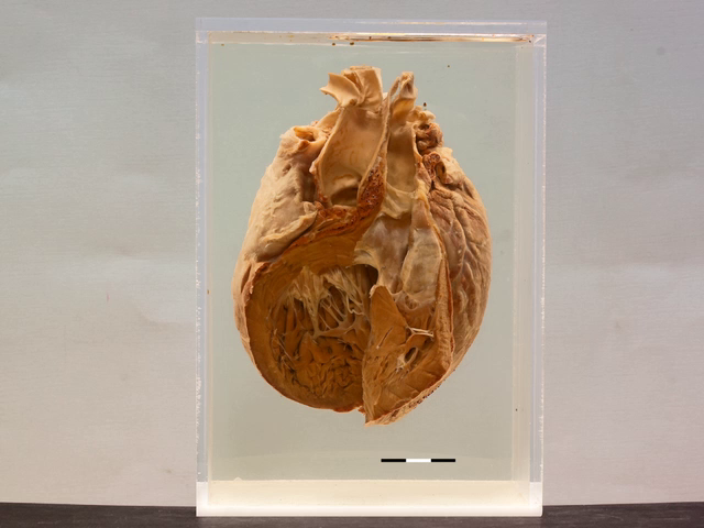 Heart Uni-ventricle