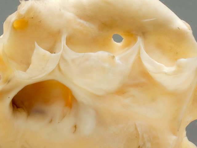 Ventricular septal defect (healed)
