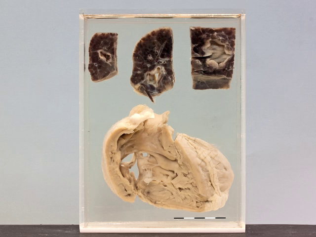 Multiple mycotic aneurysms due to bacterial endocarditis