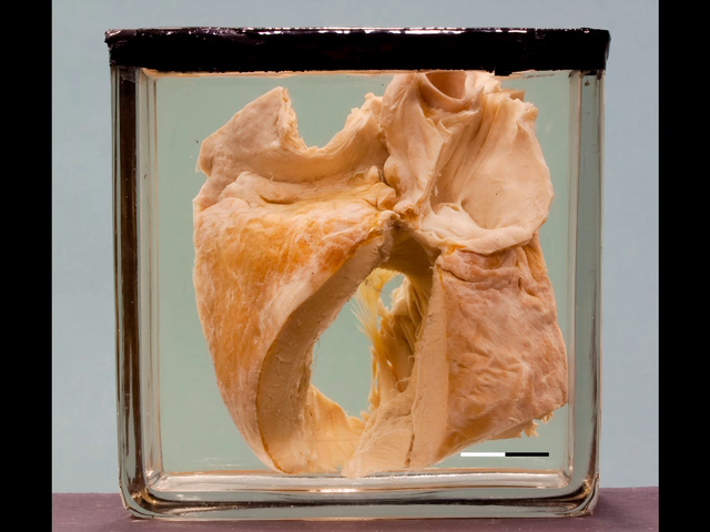 Congenital pulmonary stenosis