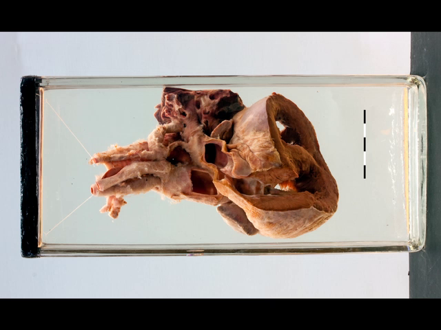 Blalock's procedure for Tetralogy of Fallot