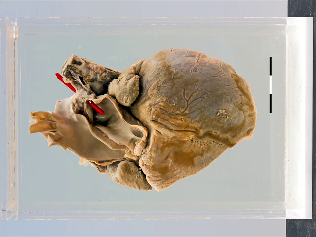 Tetralogy of Fallot