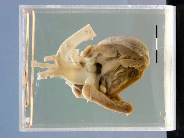 Truncus arteriosus with VSD