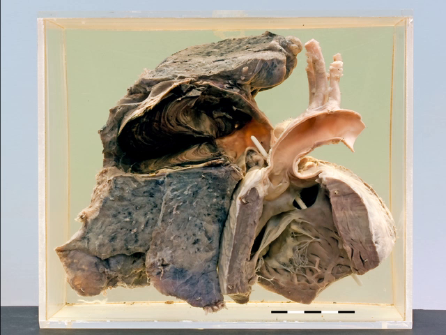 Transposition with a massive pulmonary artery aneurysm