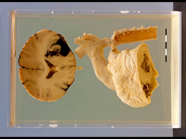 Coarctation with intra-cerebral haemorrhage