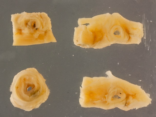 Coronary atheroma